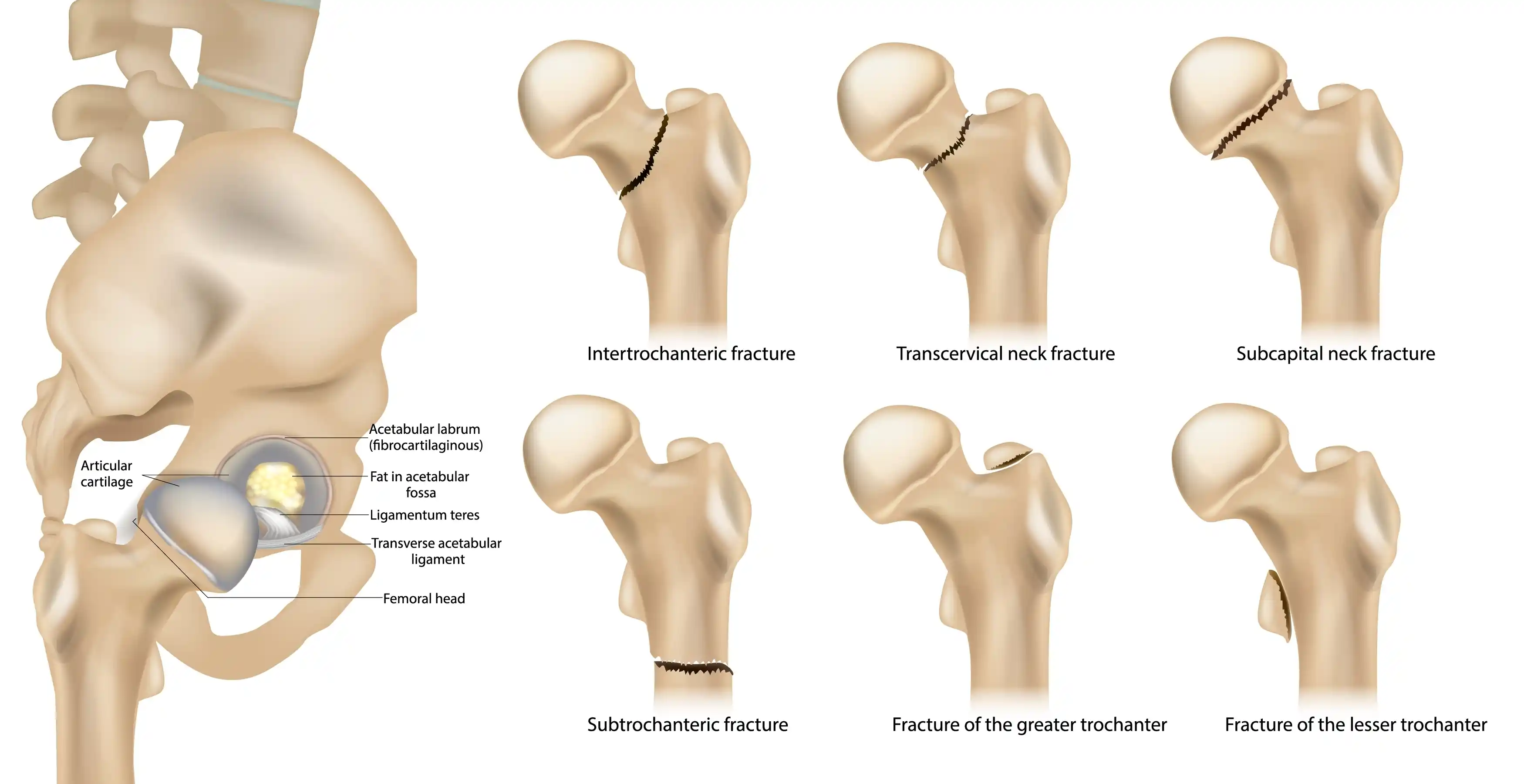 femur-fracture