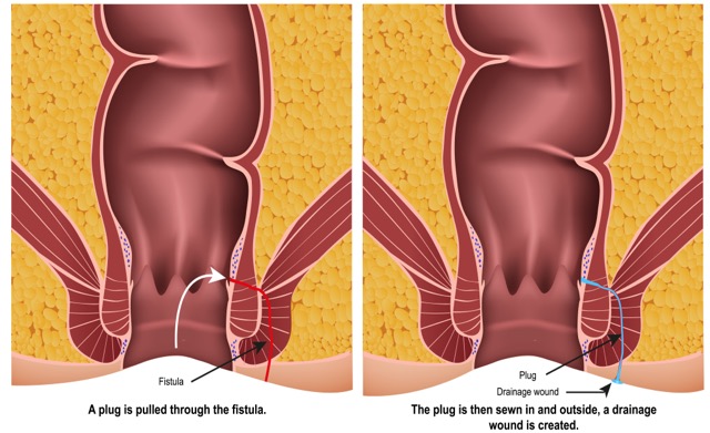 fistulectomy