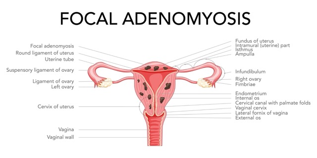 focal-adenomyosis