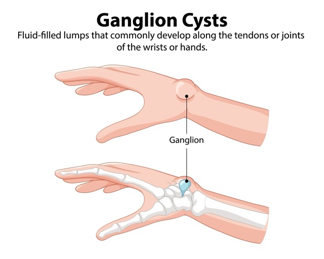 ganglion-cyst-removal