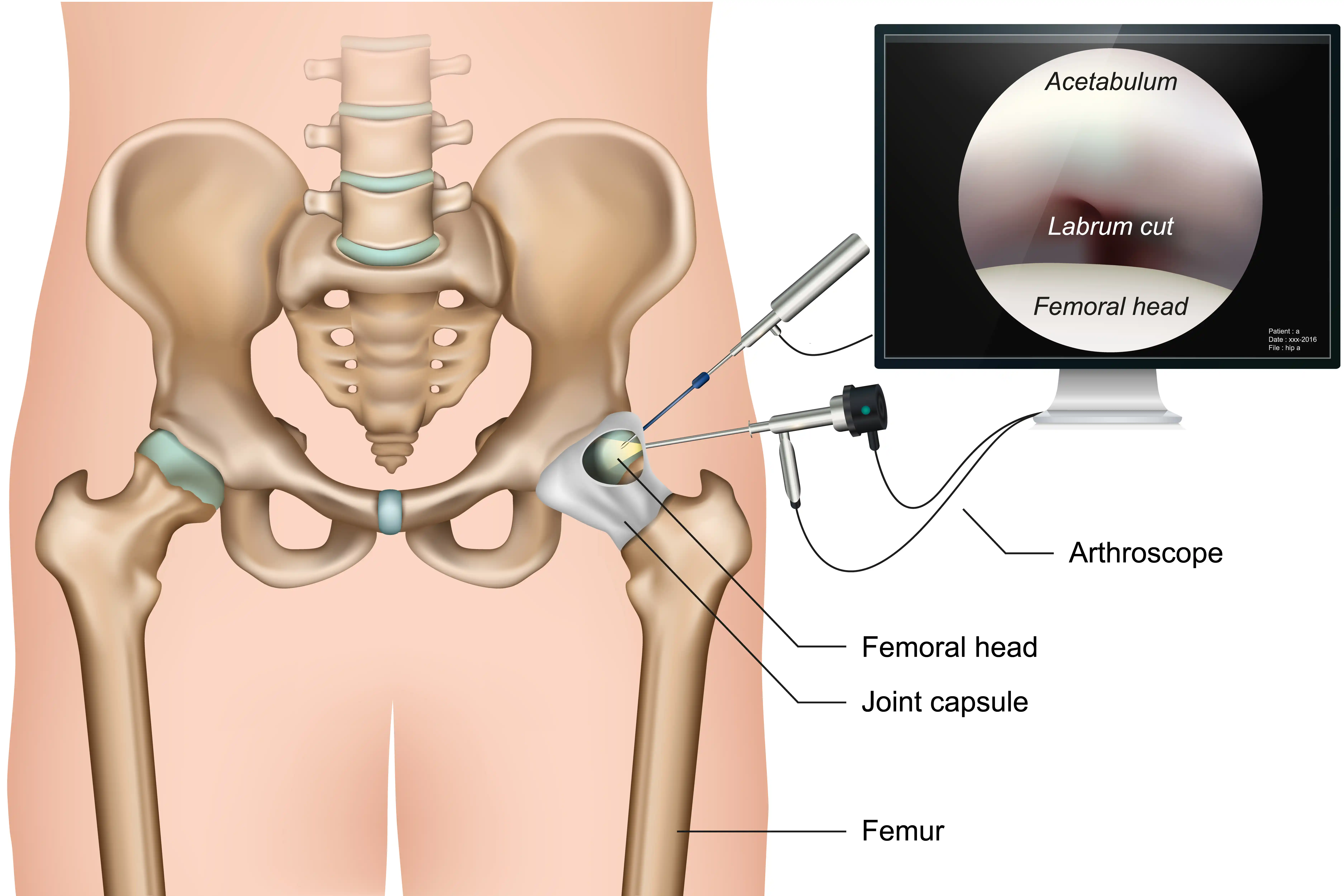 hip-arthroscopy