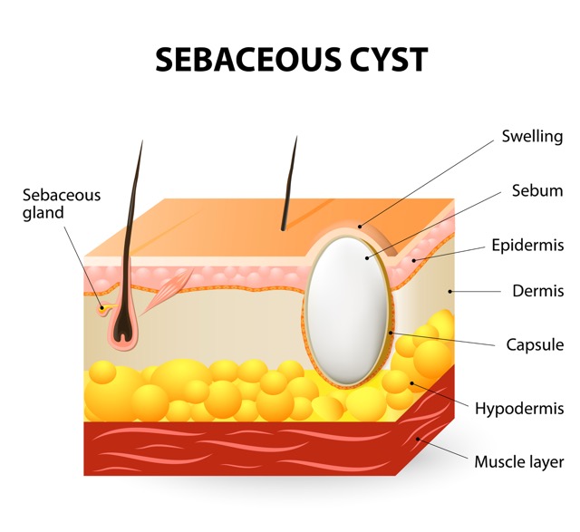 infected-sebaceous-cyst