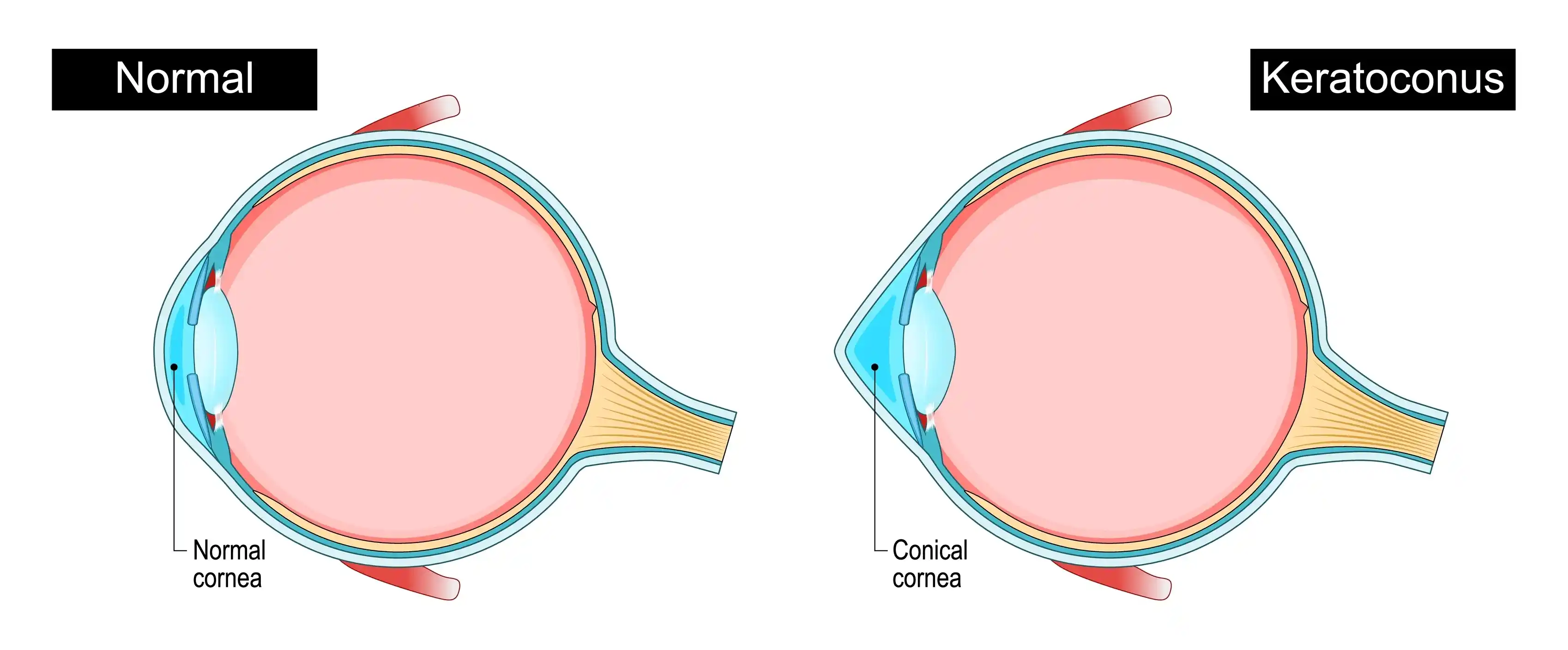 keratoconus