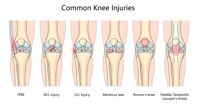 knee-ligament-injury