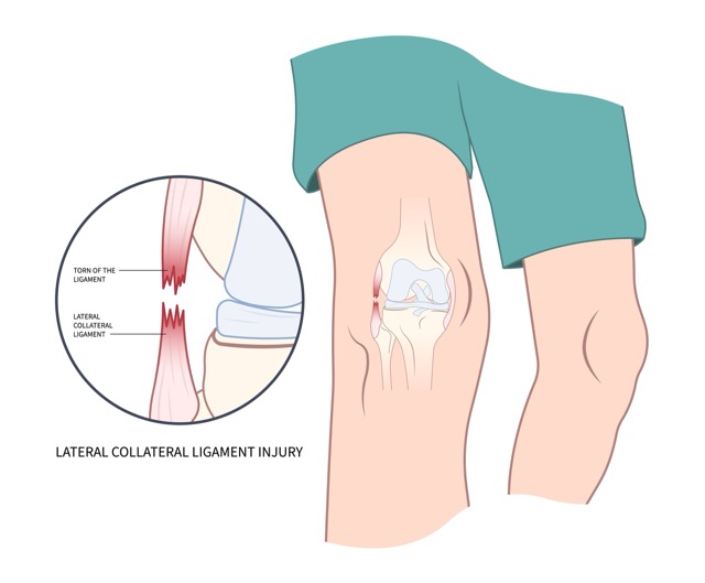 lateral-collateral-ligament