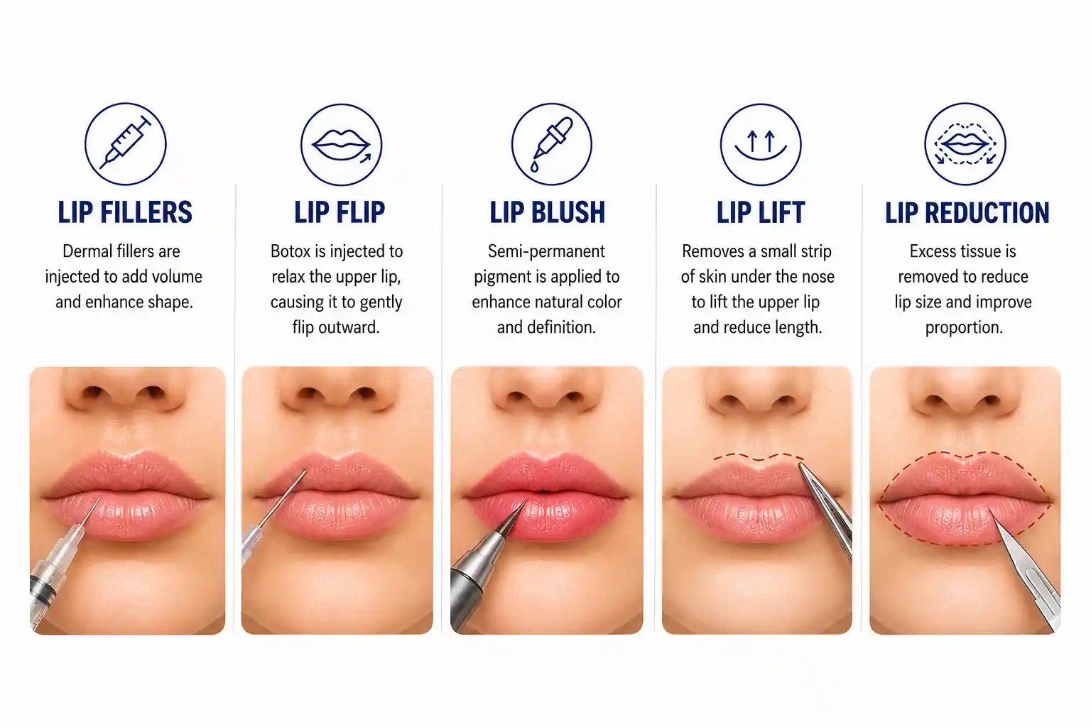 Lip-Surgery