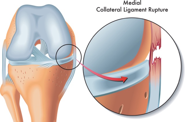 medial-collateral-ligament-reconstruction