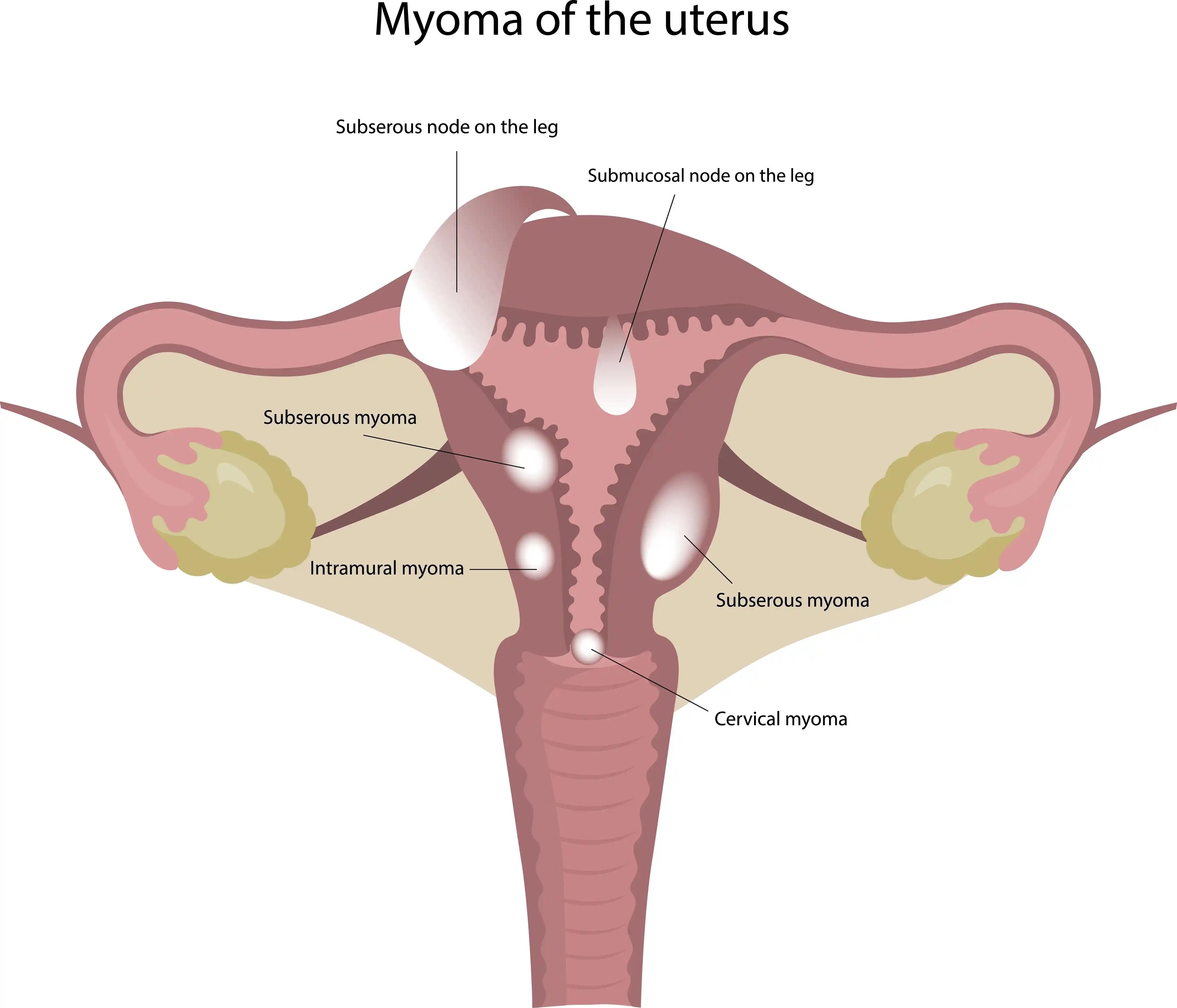 myoma