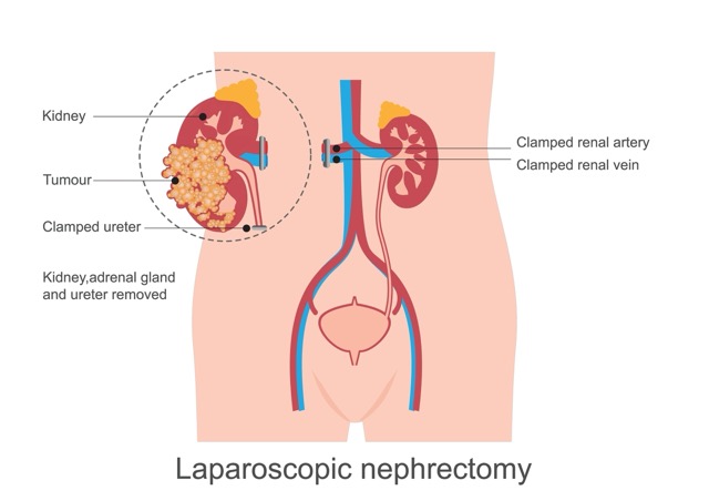 nephrectomy
