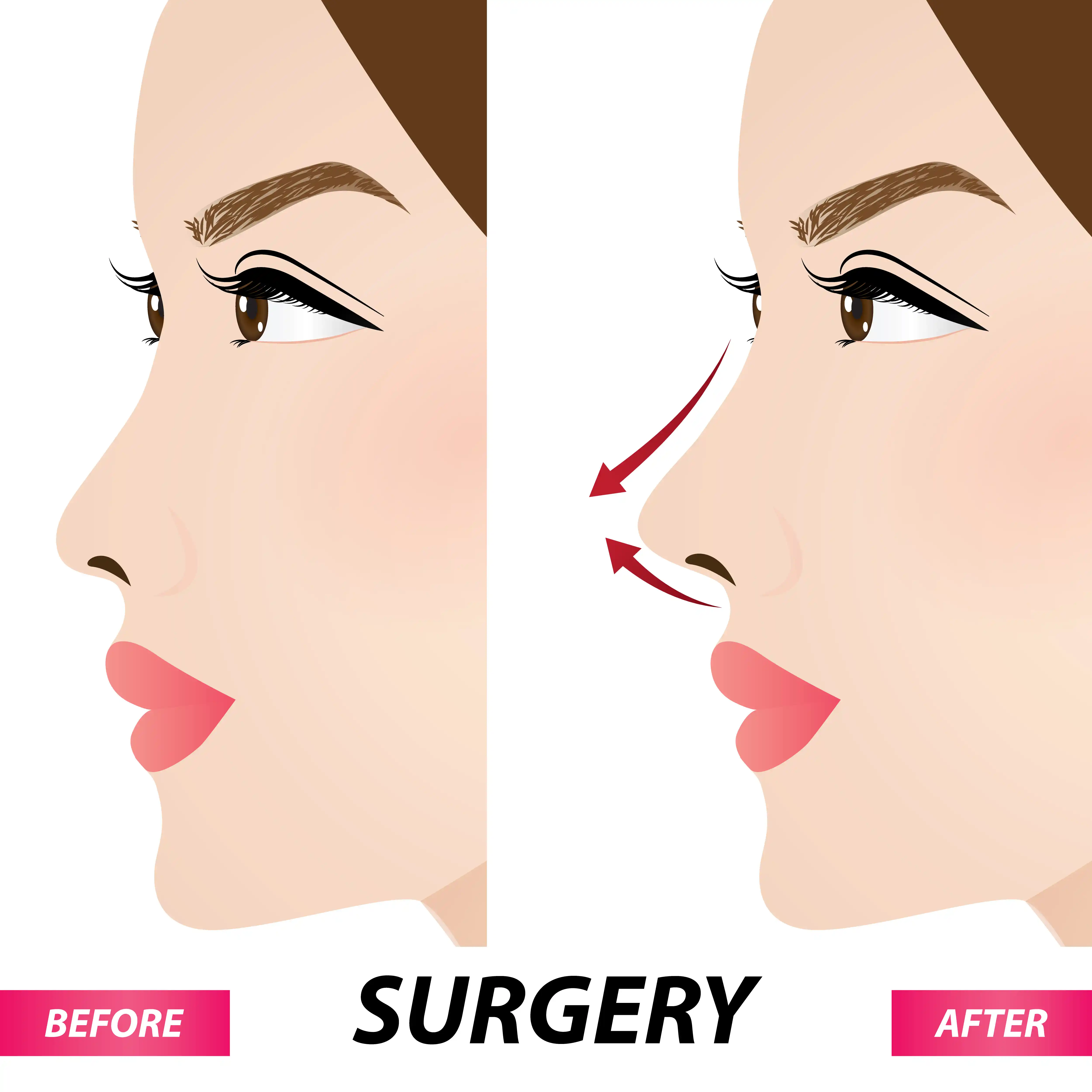 nose-reshaping