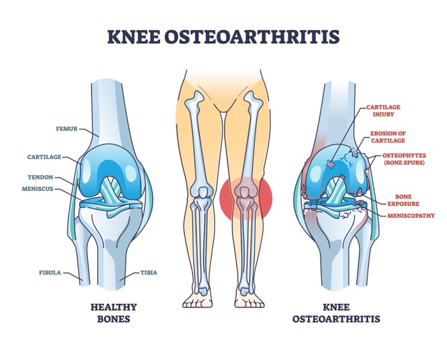 osteoarthritis