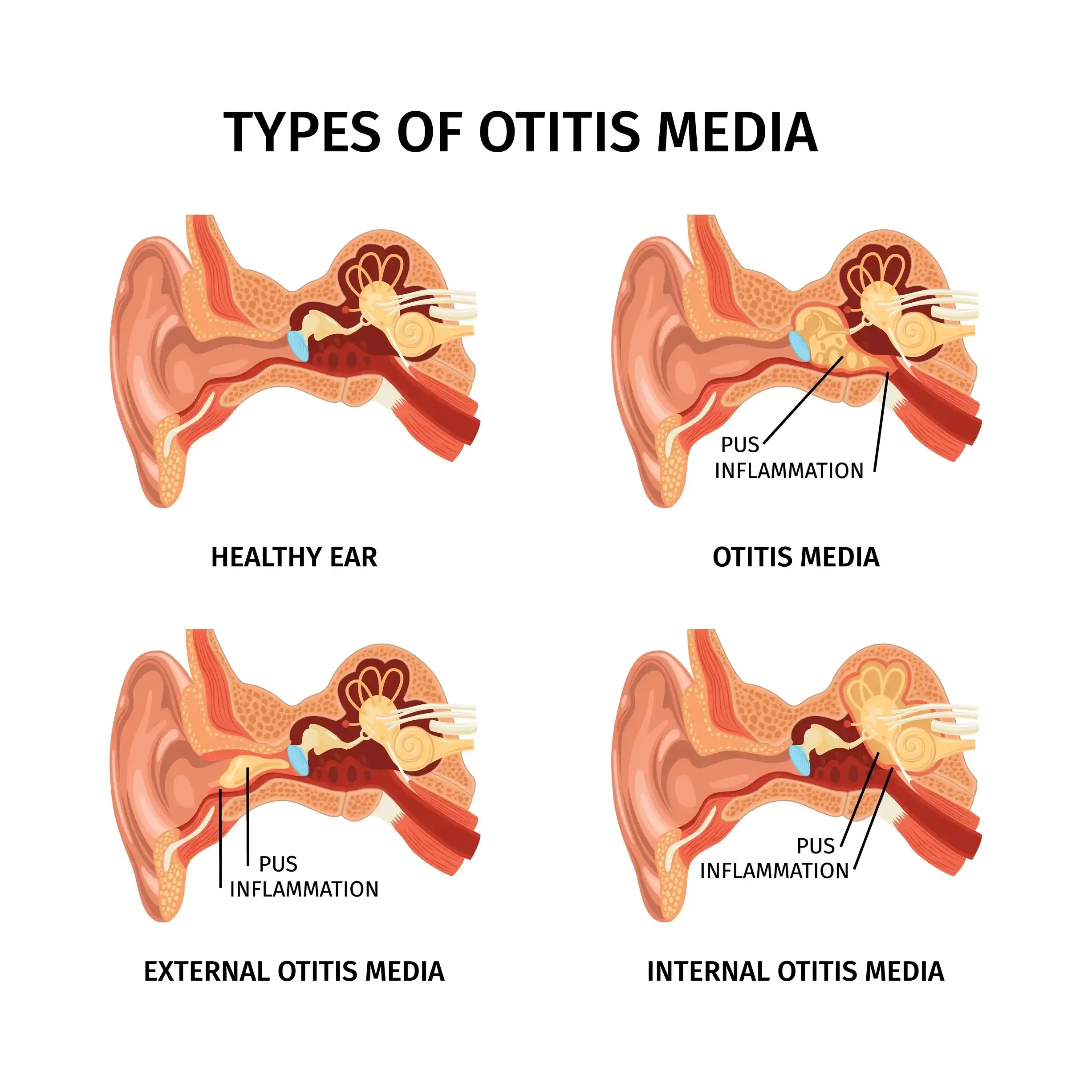 otitis-interna