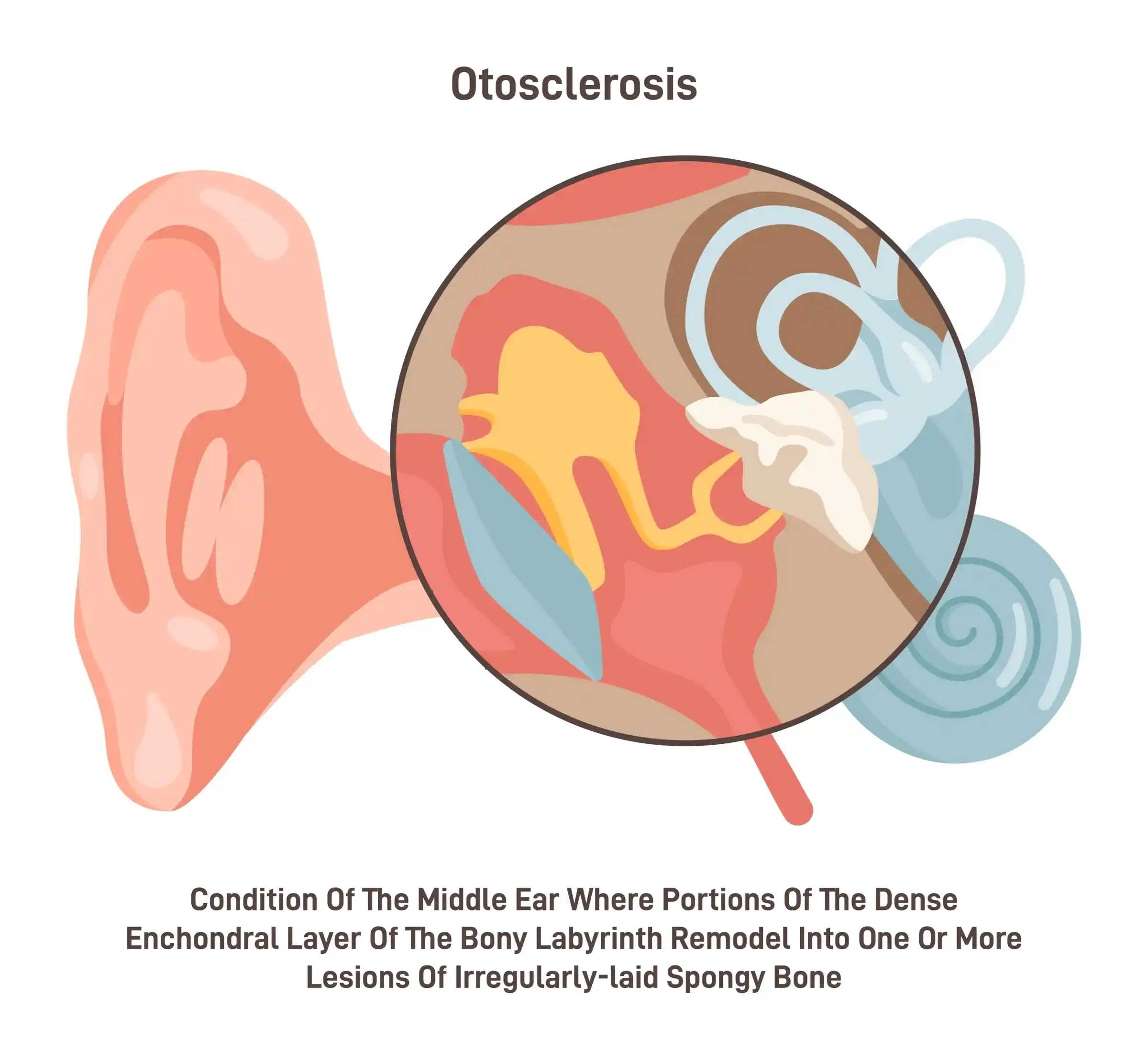 otosclerosis