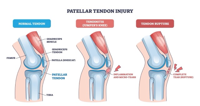 patellar-tendon-repair