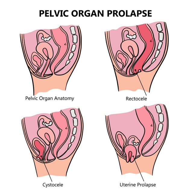 pelvic-organ-prolapse
