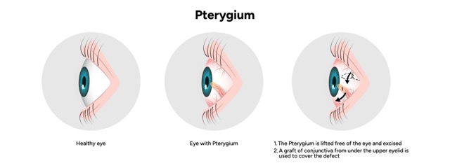 pterygium