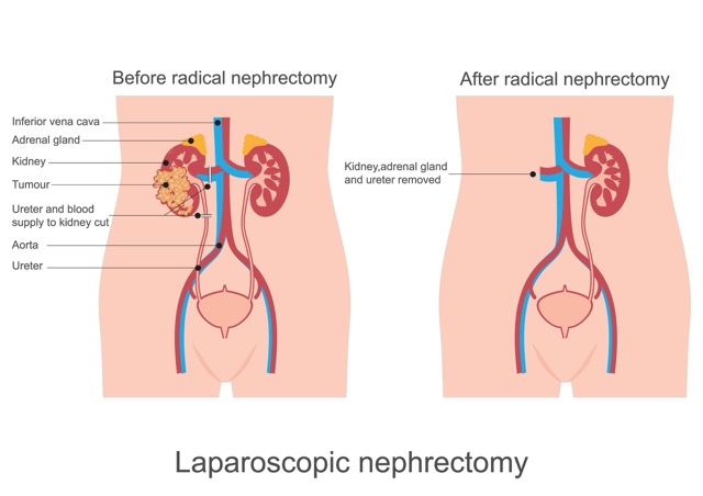 radical-nephrectomy