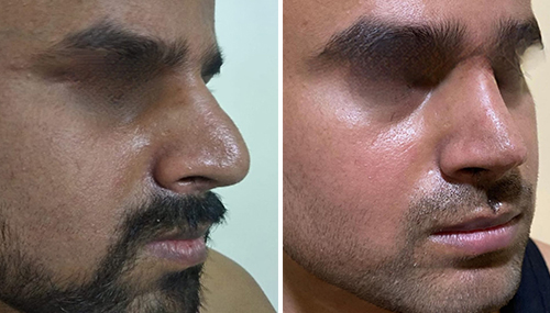 Before and After Images rhinoplasty Patient Undergone Surgery -1