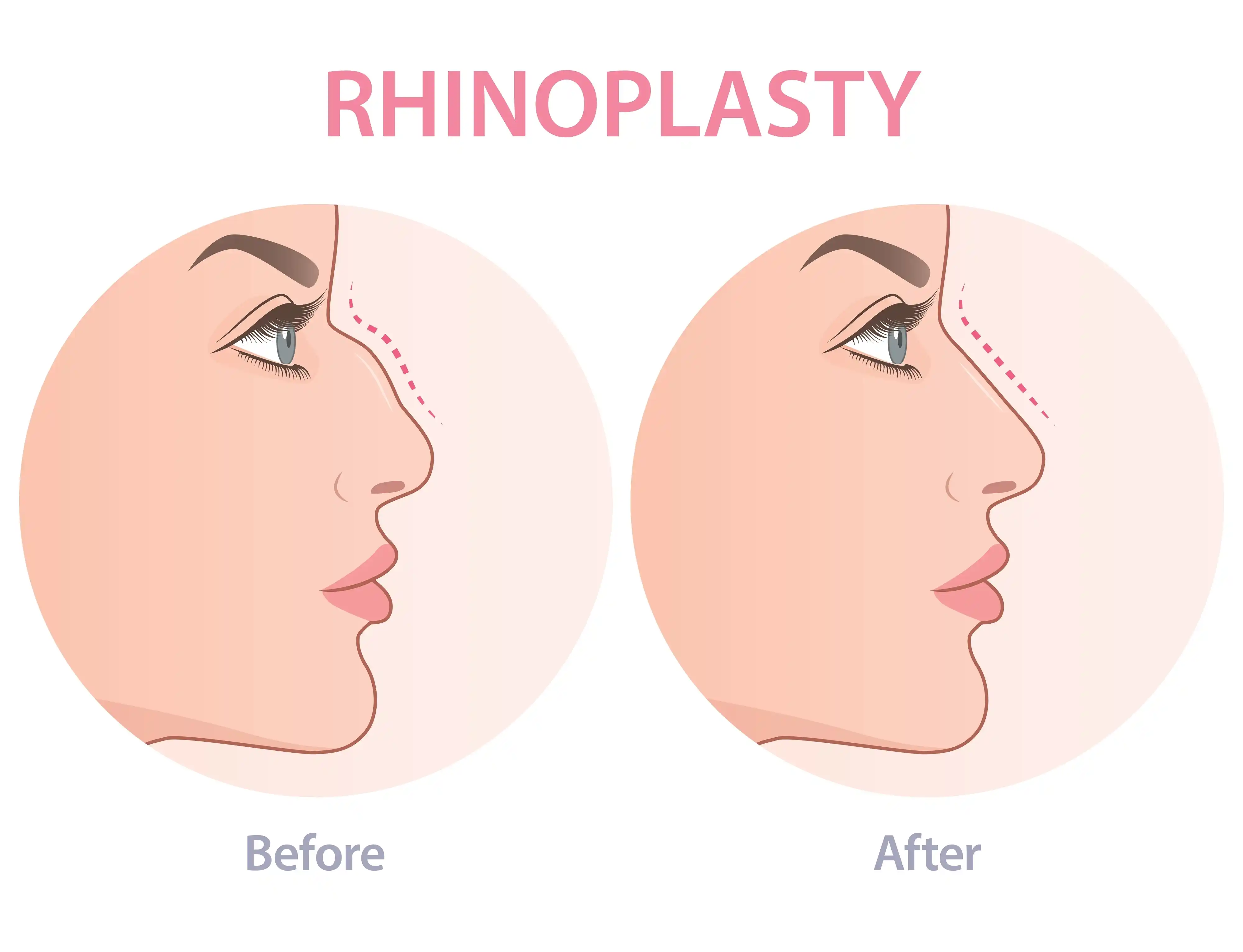 Rhinoplasty