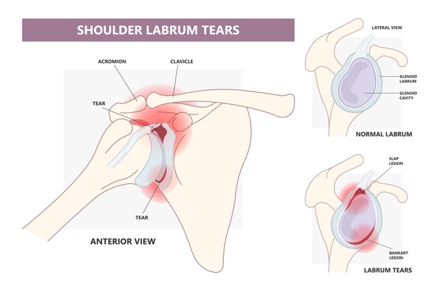shoulder-labrum-tear
