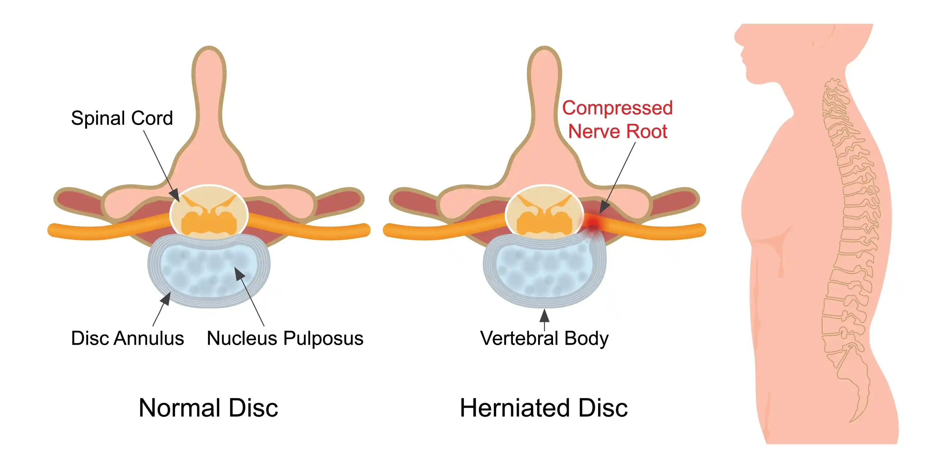 slip-disc