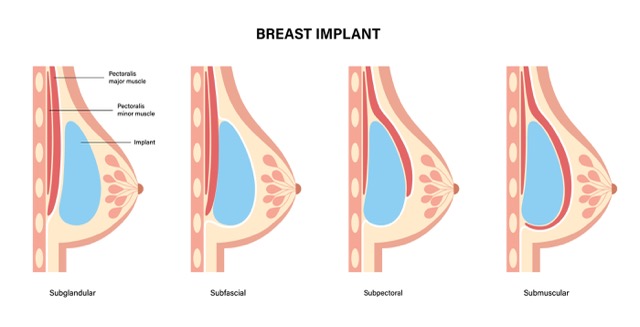 submuscular-breast-implant