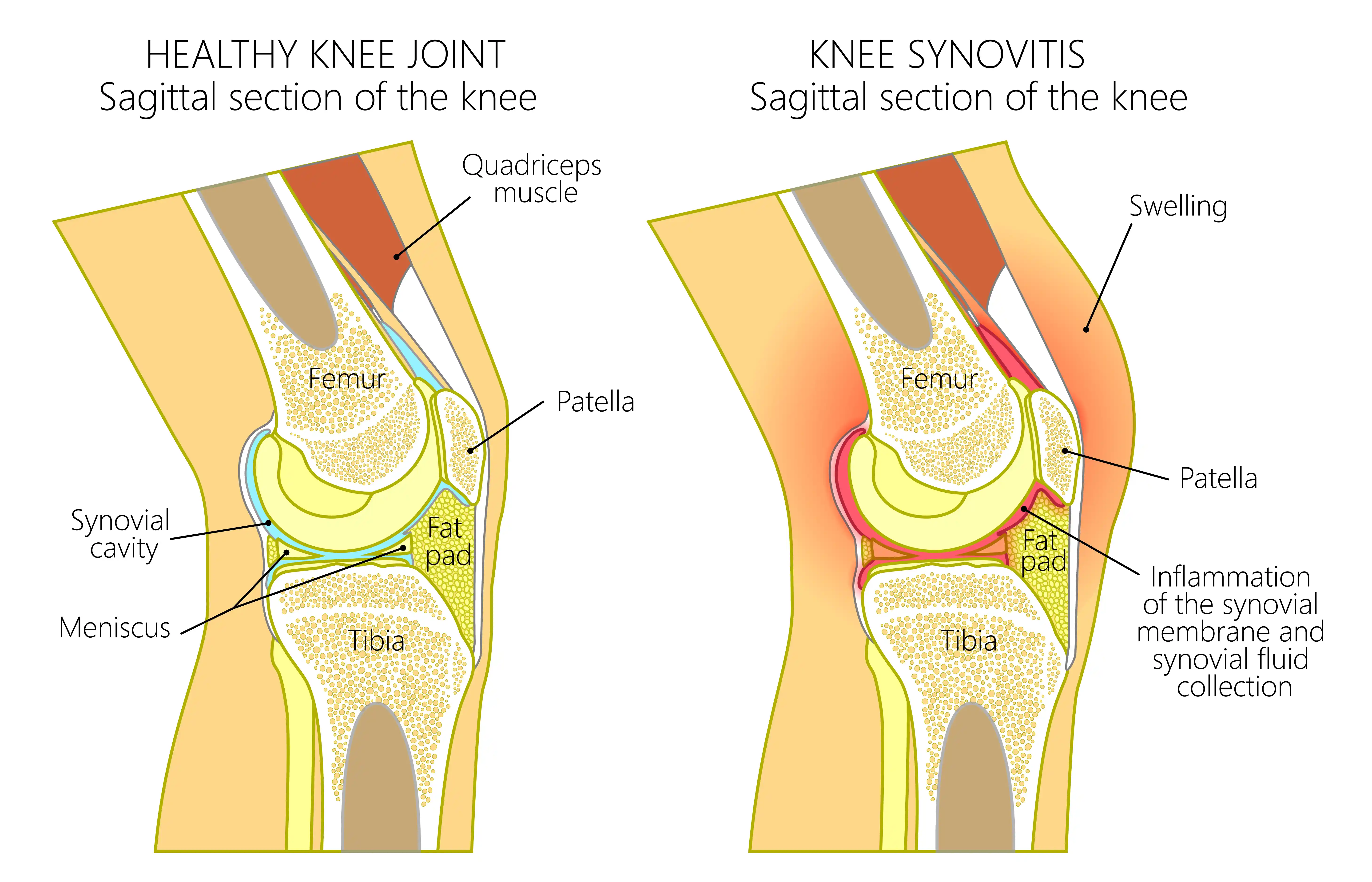 synovectomy