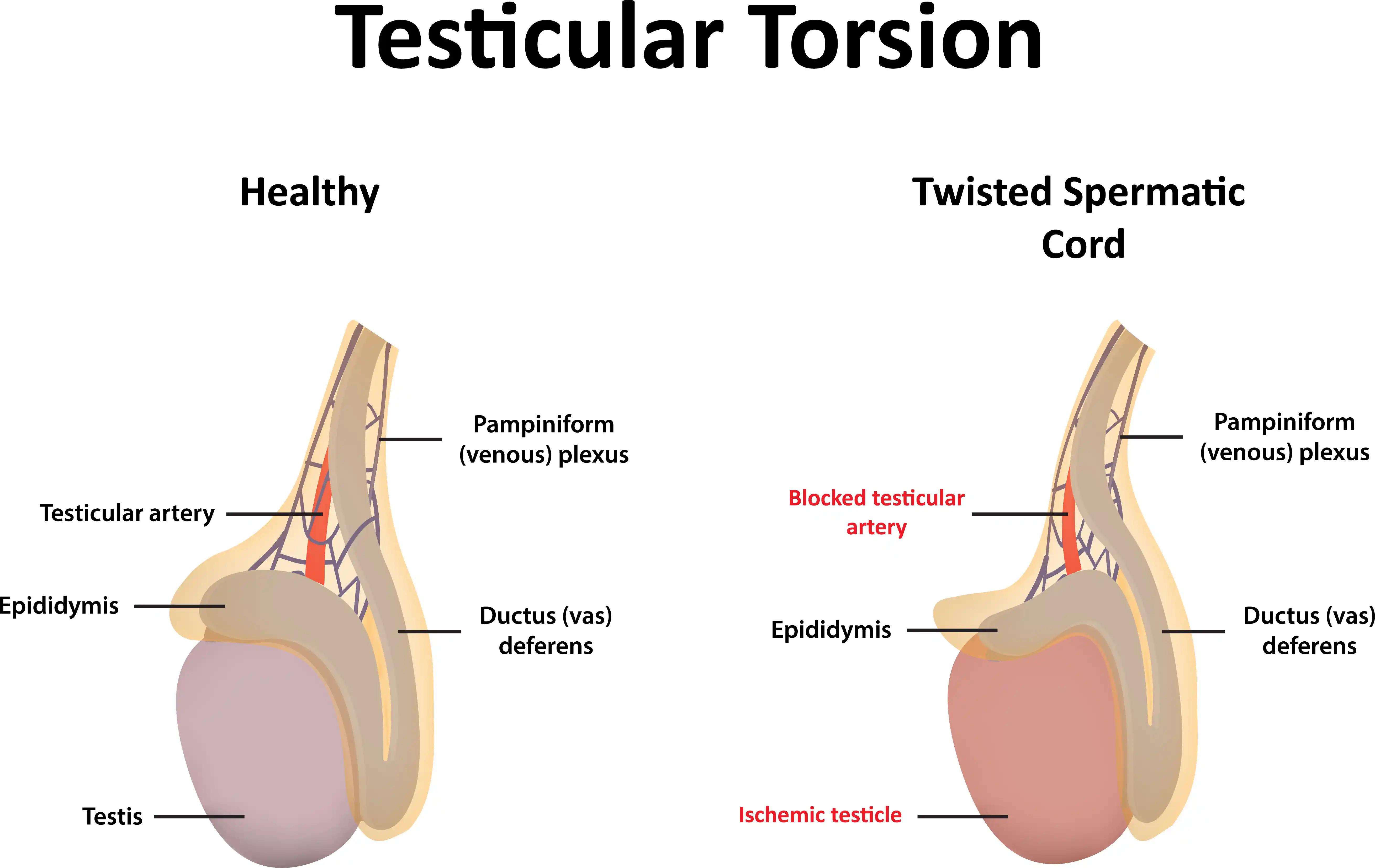 testicular-torsion