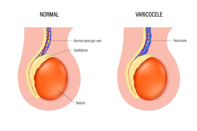 testicular-varicocelectomy