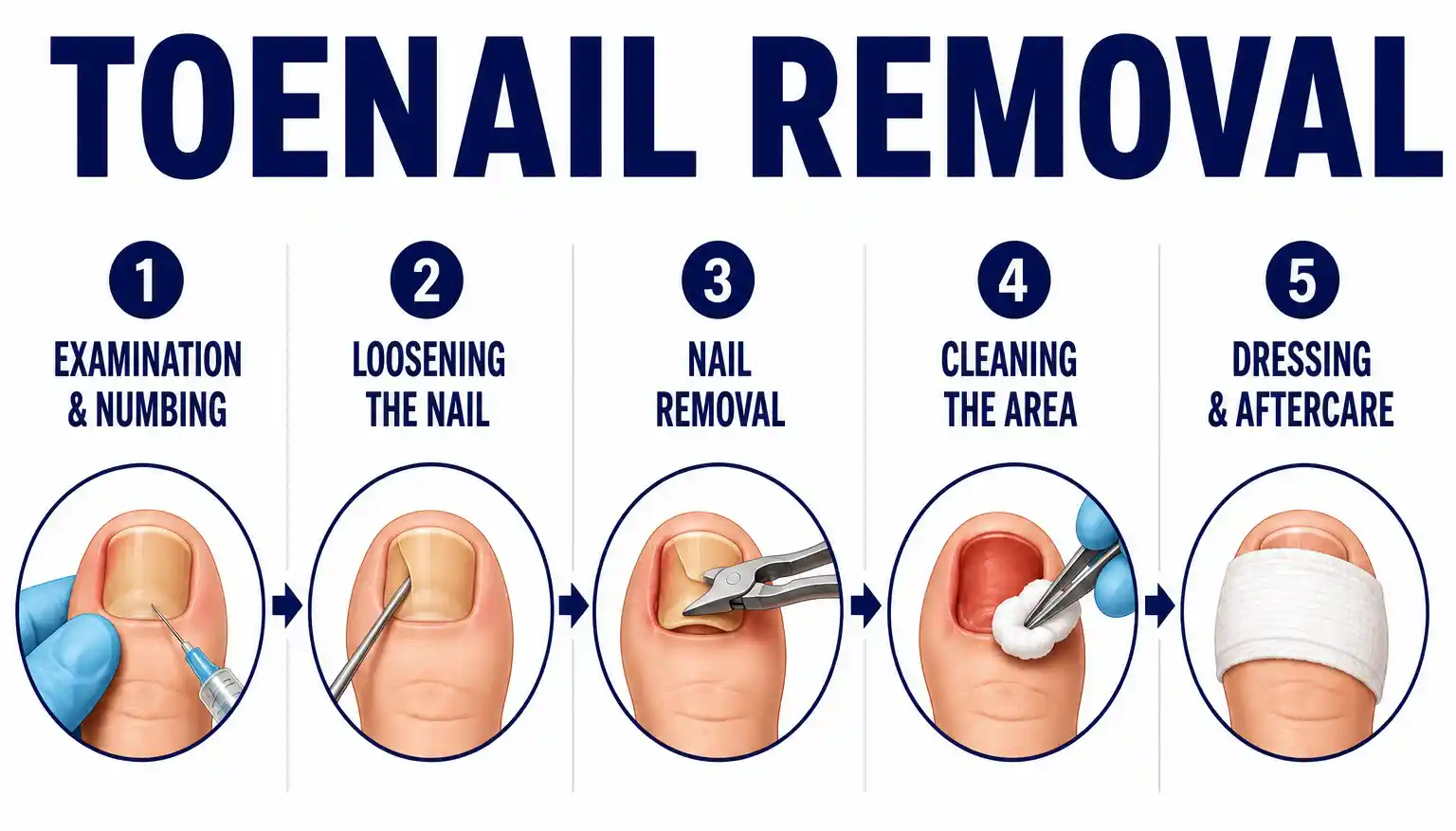 toenail-removal