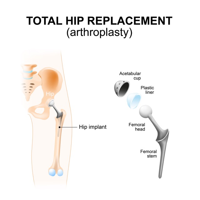 total-hip-arthroplasty