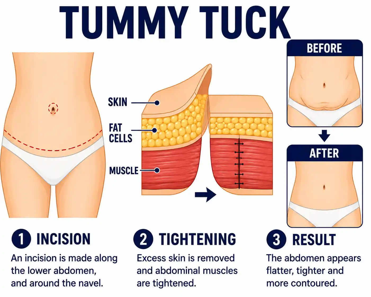 Tummy-Tuck