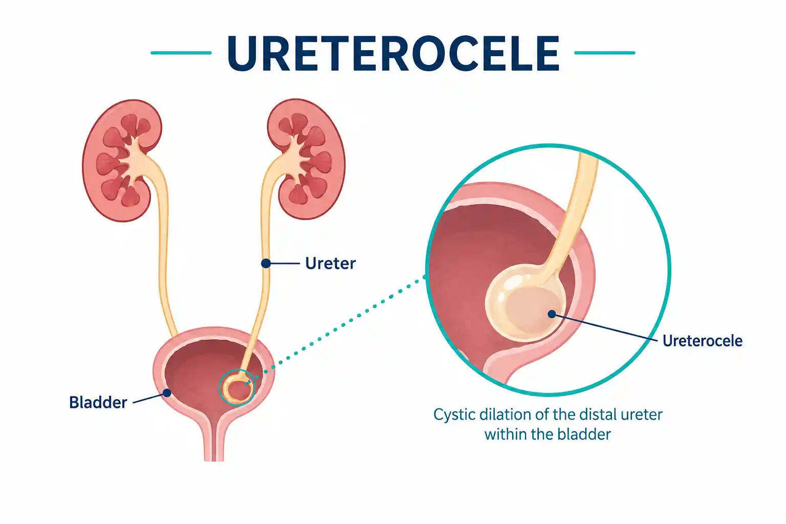 ureterocele