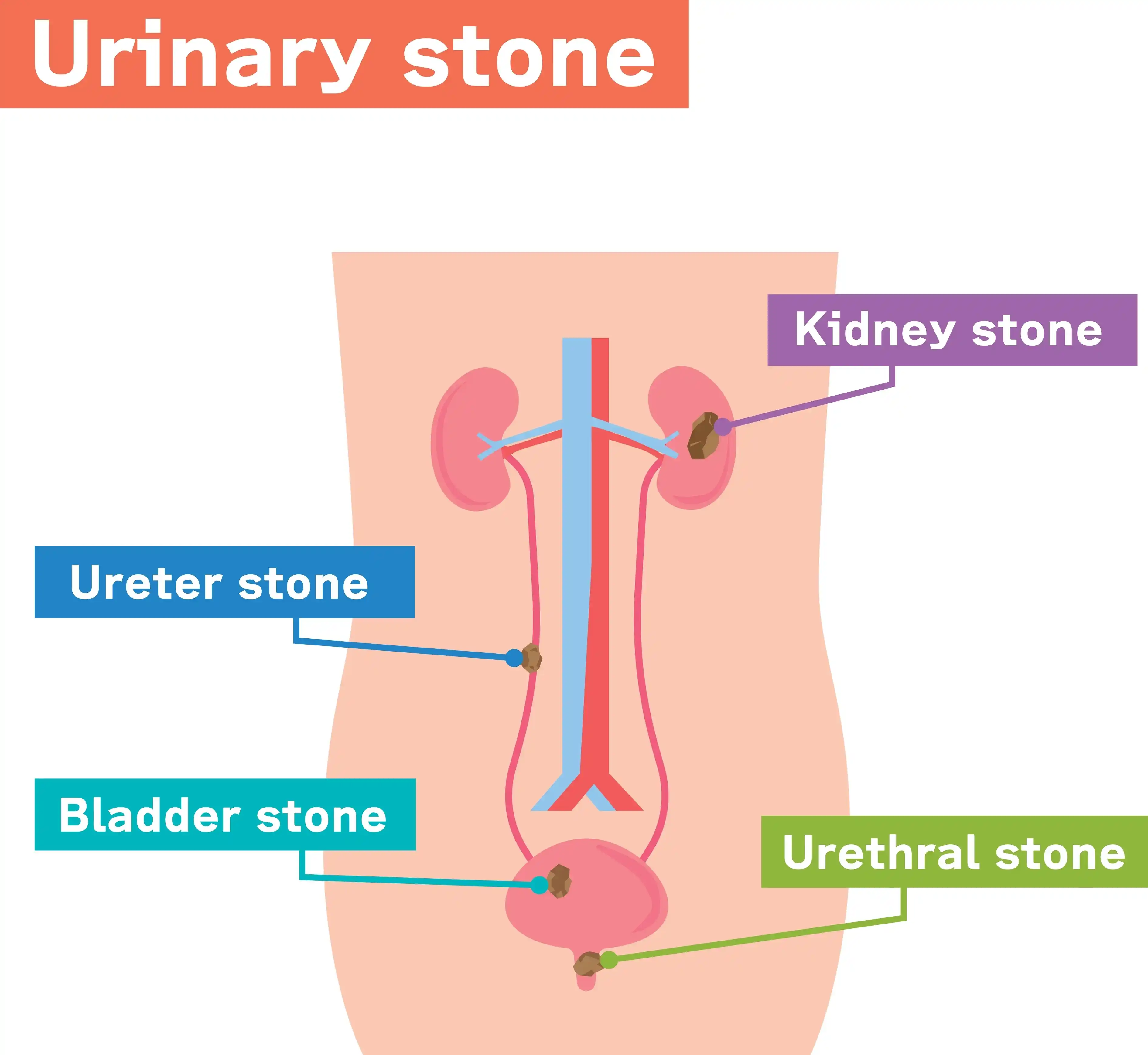 urinary-tract-stone