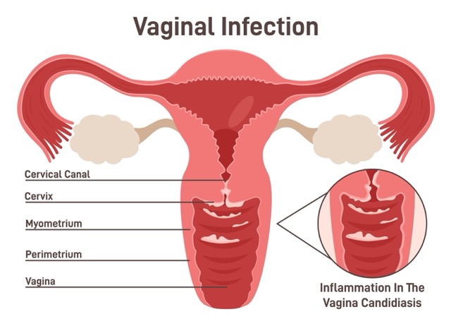 vaginal-infection
