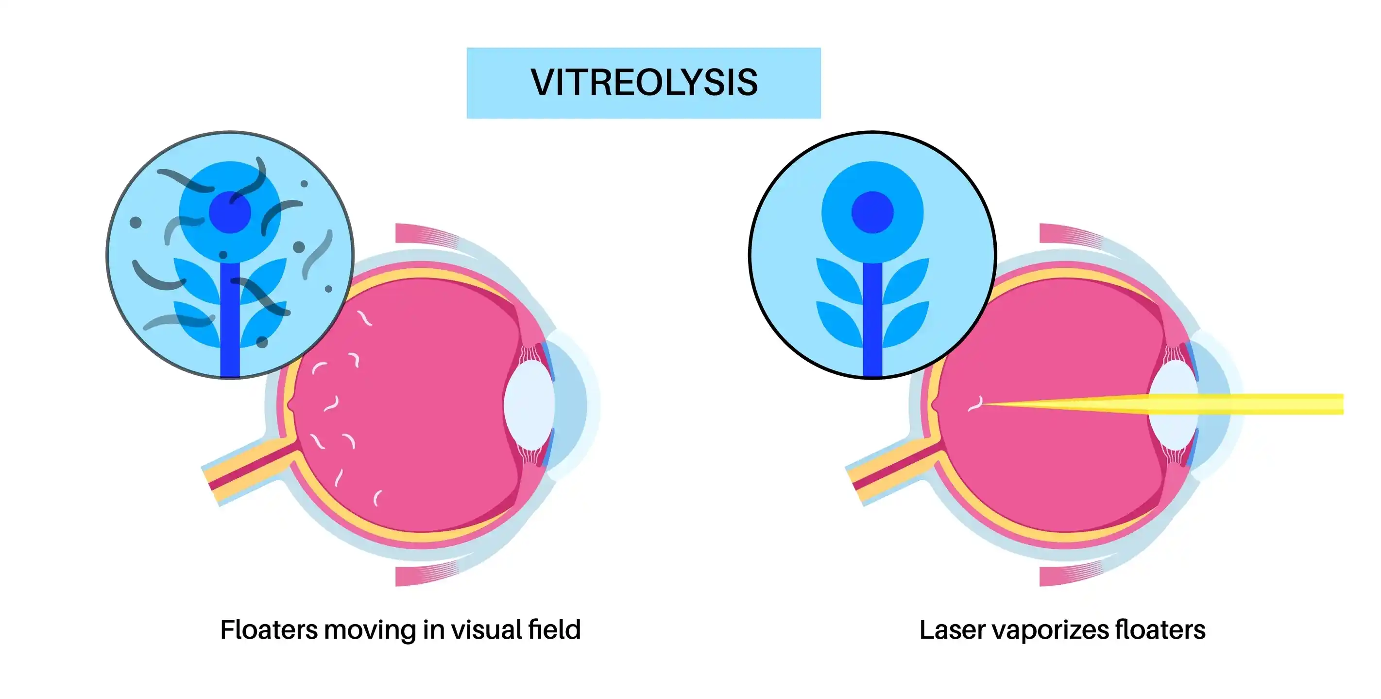 vitreo-retinal