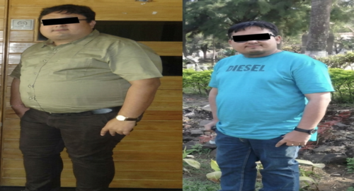 Before and After Images Patient's Underwent Bariatric Surgery - 5