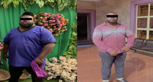 Before and After Images Patient's Underwent Bariatric Surgery - 4