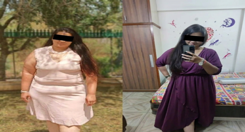 Before and After Images Patient's Underwent Bariatric Surgery - 3
