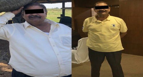 Before and After Images Patient's Underwent Bariatric Surgery - 2