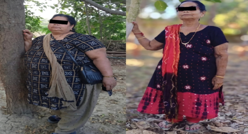 Before and After Images Patient's Underwent Bariatric Surgery - 3