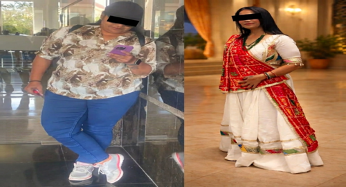 Before and After Image of a Patient Undergone Bariatric Surgery - 4