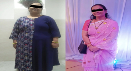 Before and After Image of a Patient undergone Bariatric Surgery - 4