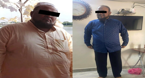 Before and After Images Patient's Underwent Bariatric Surgery - 3